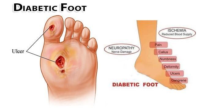 Nursing Foot Care